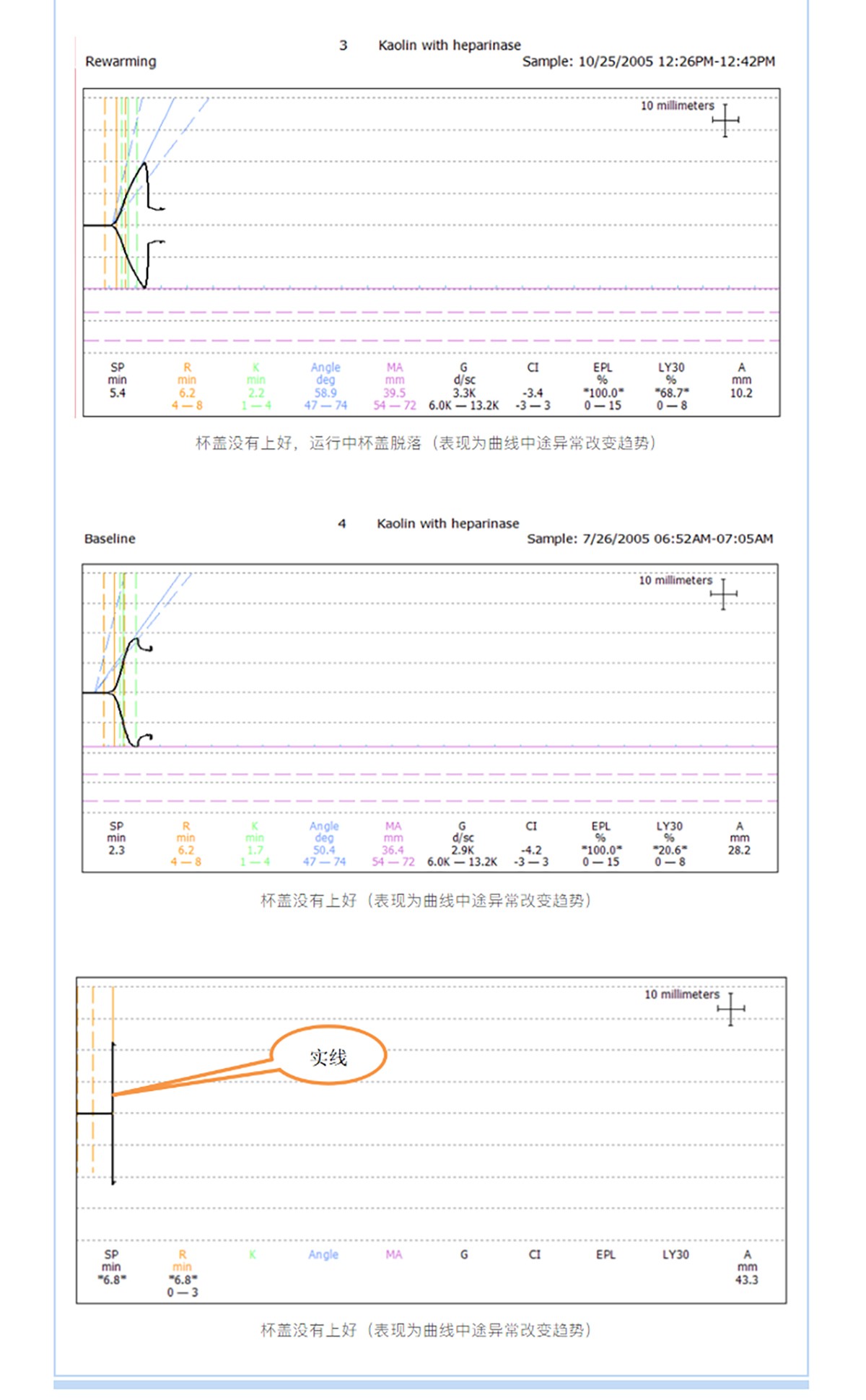 血栓弹力图常见图形异常分析_03.jpg